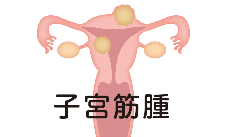 子宮筋腫について さいたま市の産婦人科 丸山記念病院
